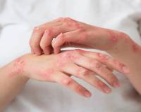 Psoriasis Skincare : लाल डाग, खाज आणि… हिवाळ्यात वाढू शकतो सोरायसिस; ‘या’ टिप्स देतील आराम